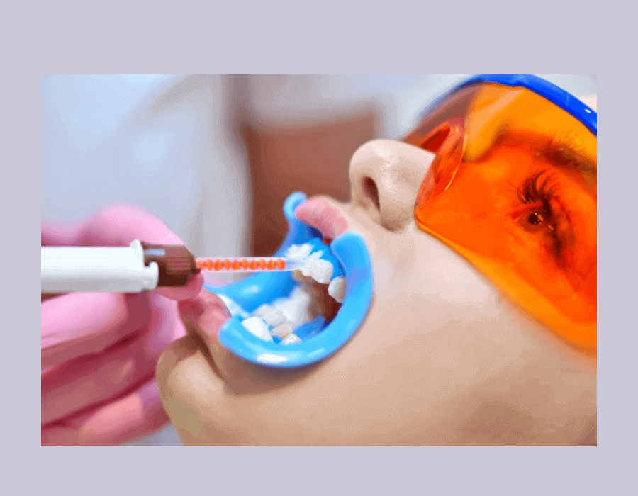 Tooth cupping