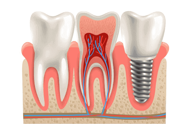 Single Tooth Implant Cost without Insurance: All You Need to Know