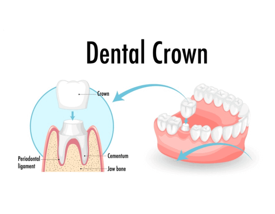 Disadvantages of Dental Crowns: What you need to know?