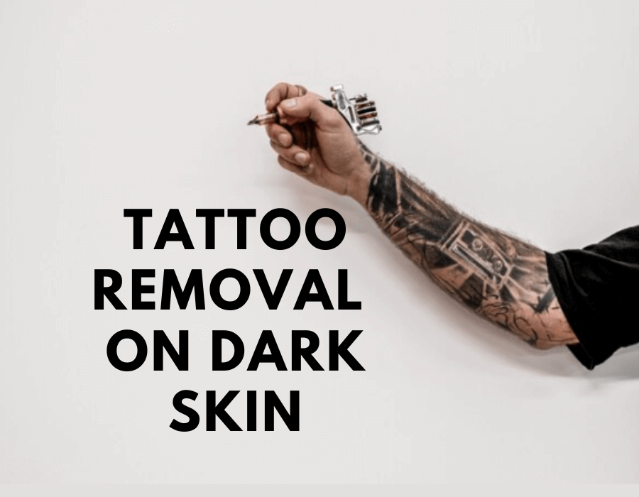 Tattoo Removal on Dark Skin: What you really need to know?
